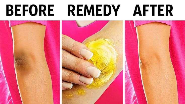 10 Natural Tricks to Remove Dark Knees and Elbows