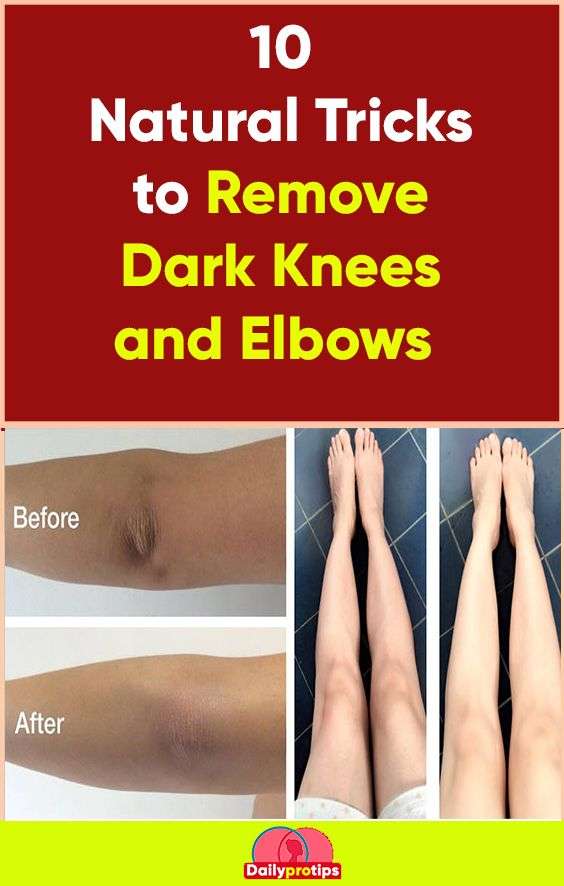10 Natural Tricks to Remove Dark Knees and Elbows in 2020