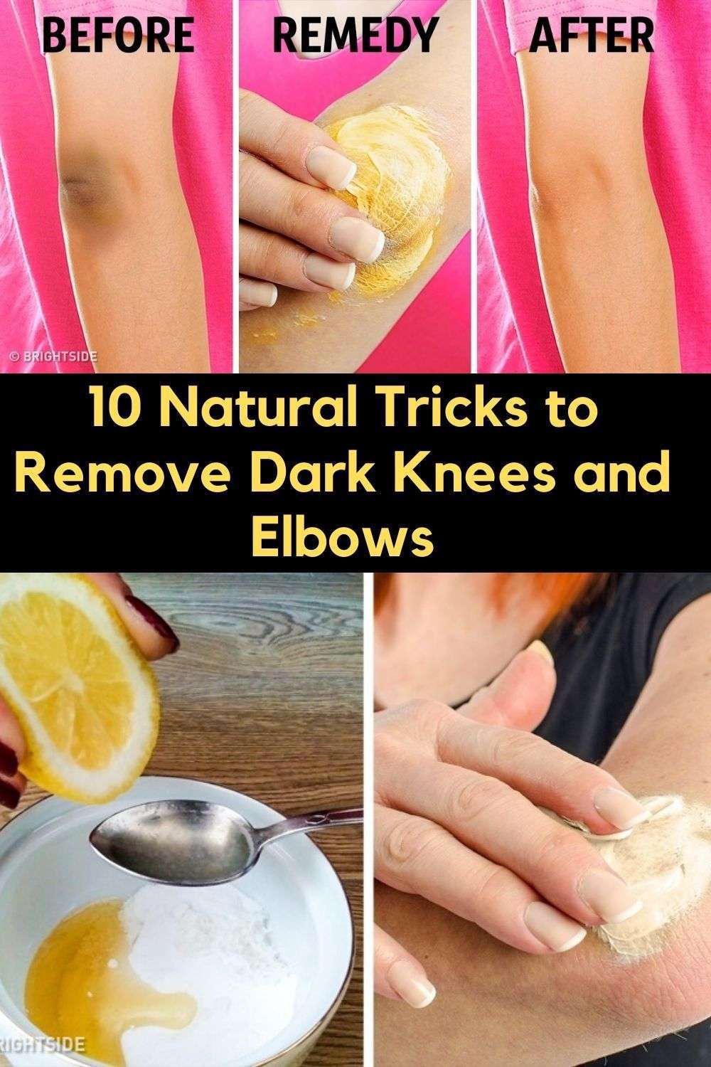 10 Natural Tricks to Remove Dark Knees and Elbows ...