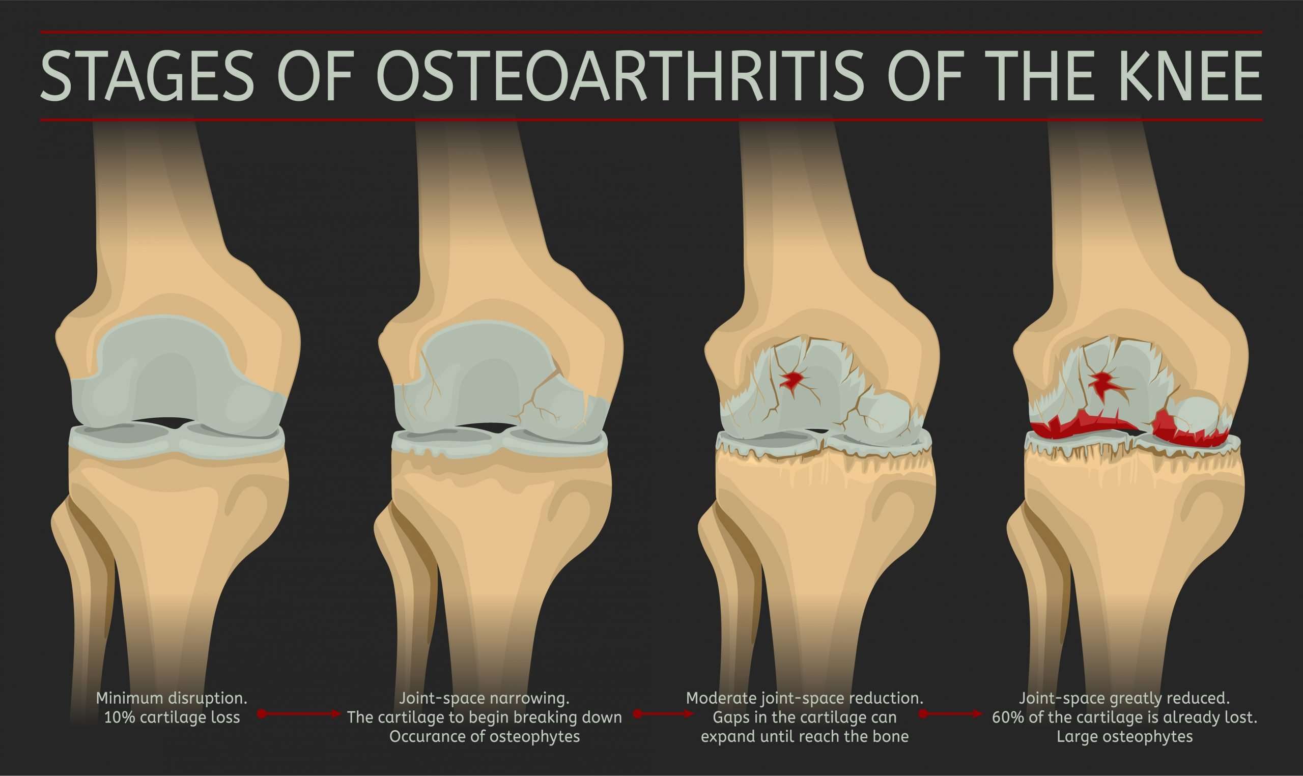 10 Recommendations To Thrive With Osteoarthritis of the Knee