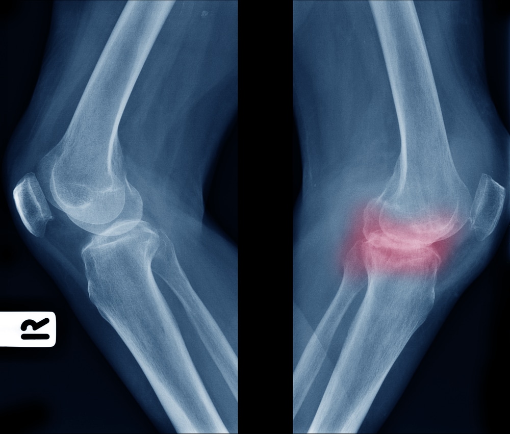 10 Symptoms of Knee Pain