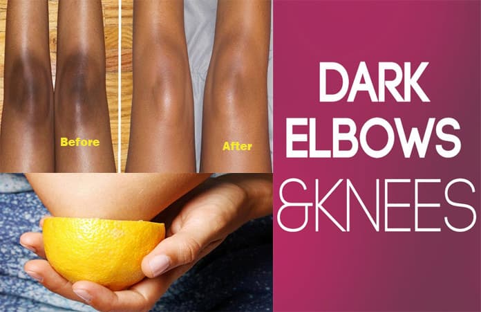 11 Home Remedies to Get Rid of Dark Elbows and Knees Fast ...