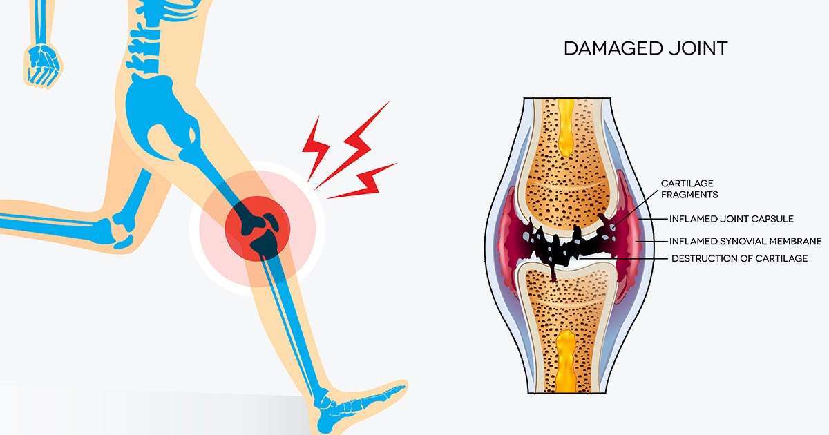 11 Worst Knee Pain Causes That Cant Be Ignored