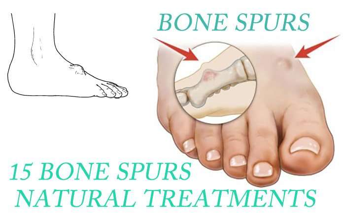 15 Bone Spurs (Neck And Knee) Natural Treatments That Work ...