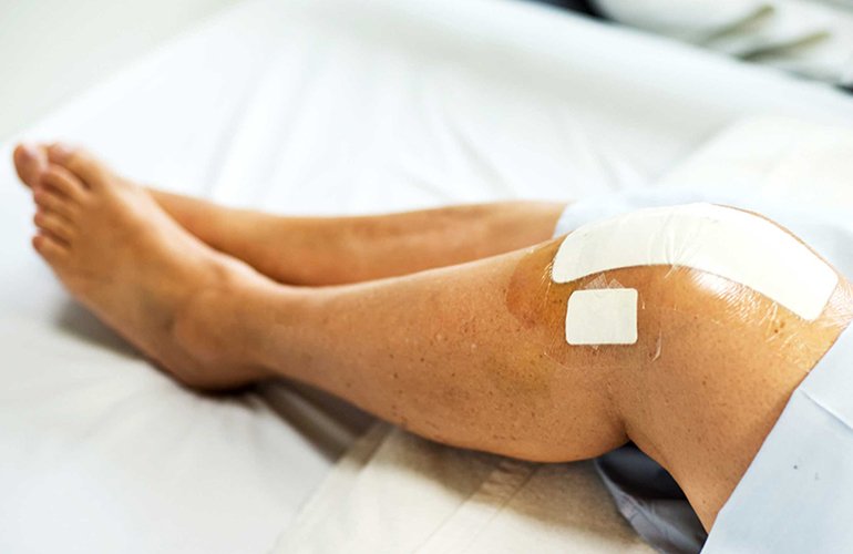 15 things you need to know about knee replacement