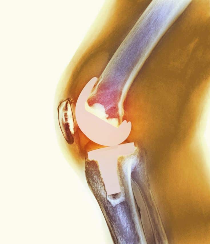 17 best Total Knee Replacement images on Pinterest