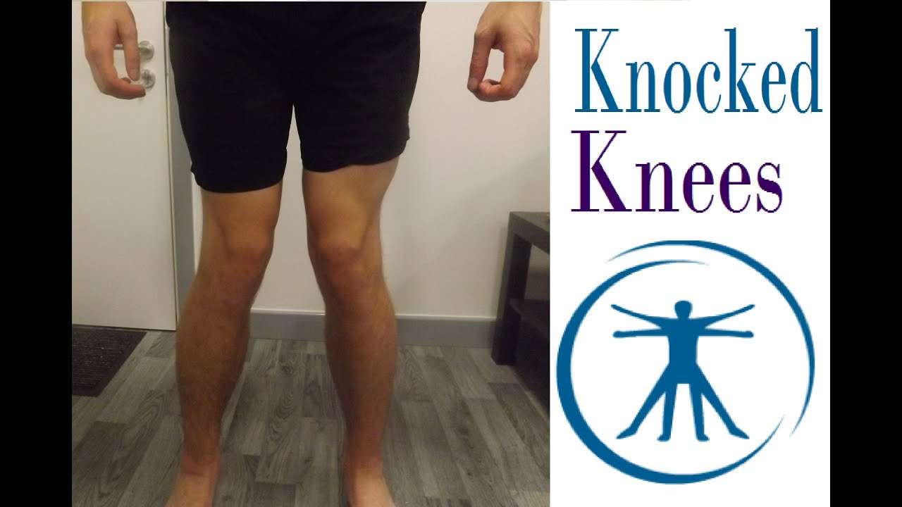 2 Exercises To Fix Knocked Knees (Genu Valgum)
