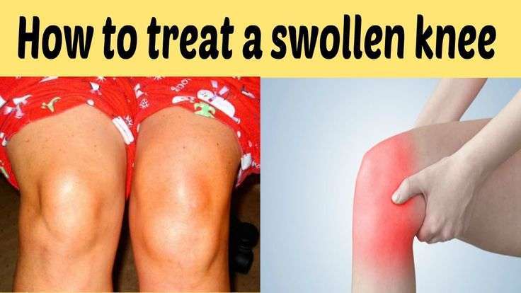 20 scientifically proven ways to treat a swollen knee at ...