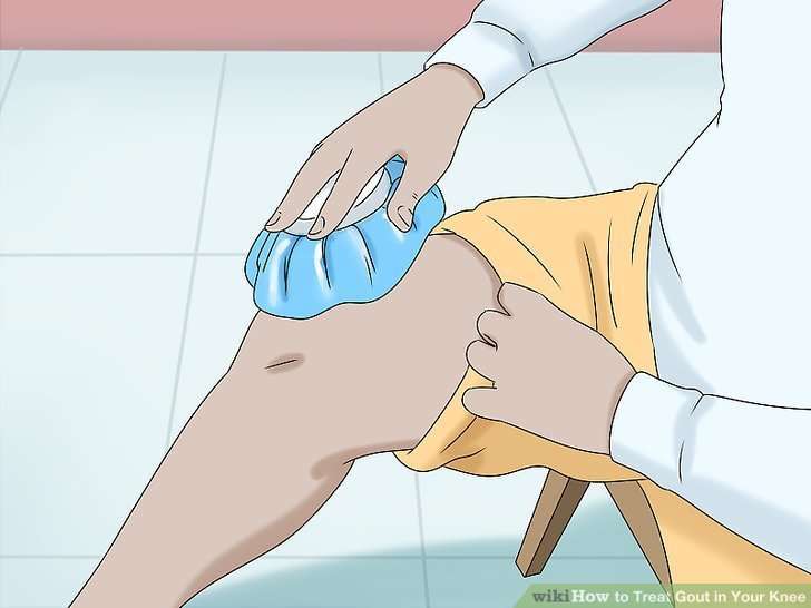 3 Easy Ways to Treat Gout in Your Knee