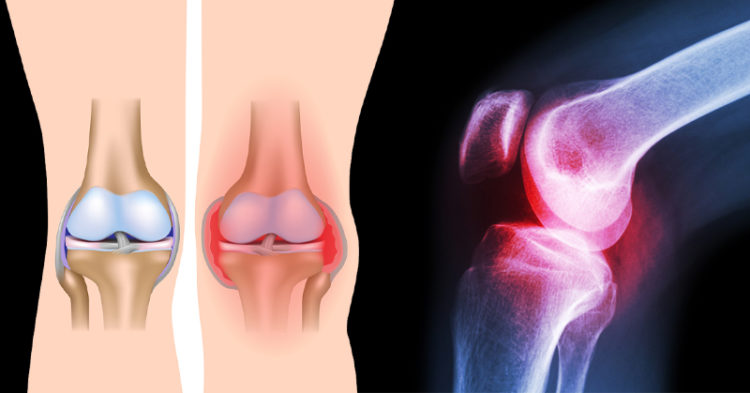 3 Simple Exercises That Heal Knee Pain Without Surgery Or ...