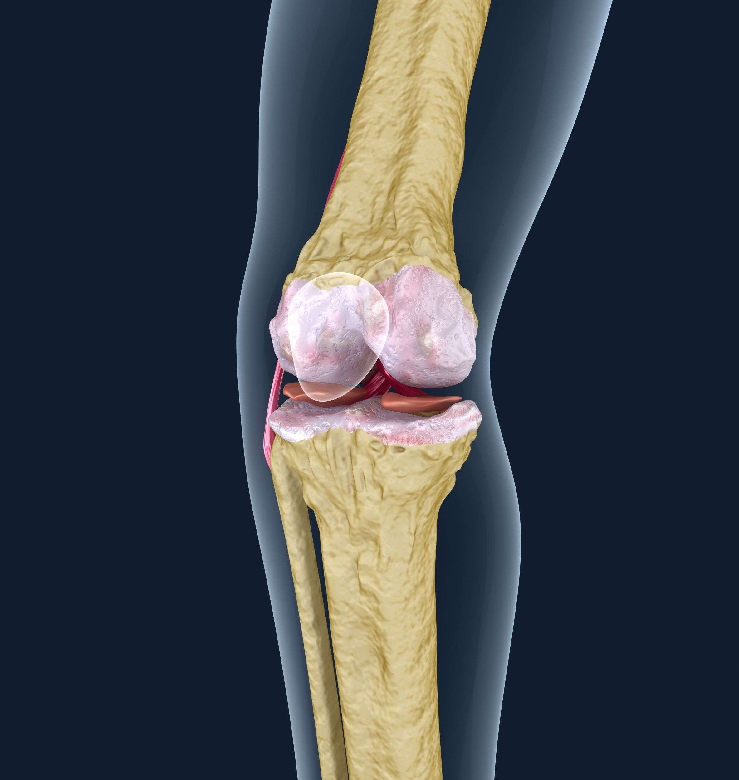 3D Osteoporosis of the knee joint