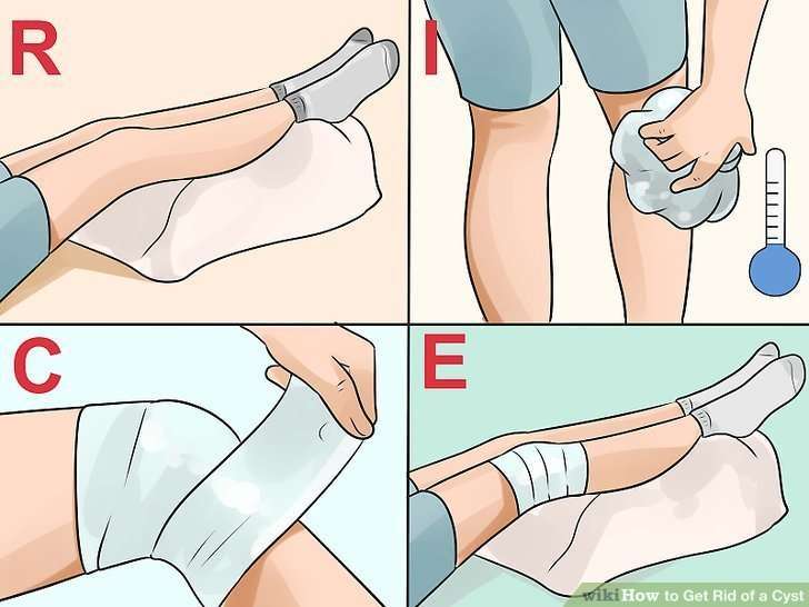 4 Ways to Get Rid of a Cyst