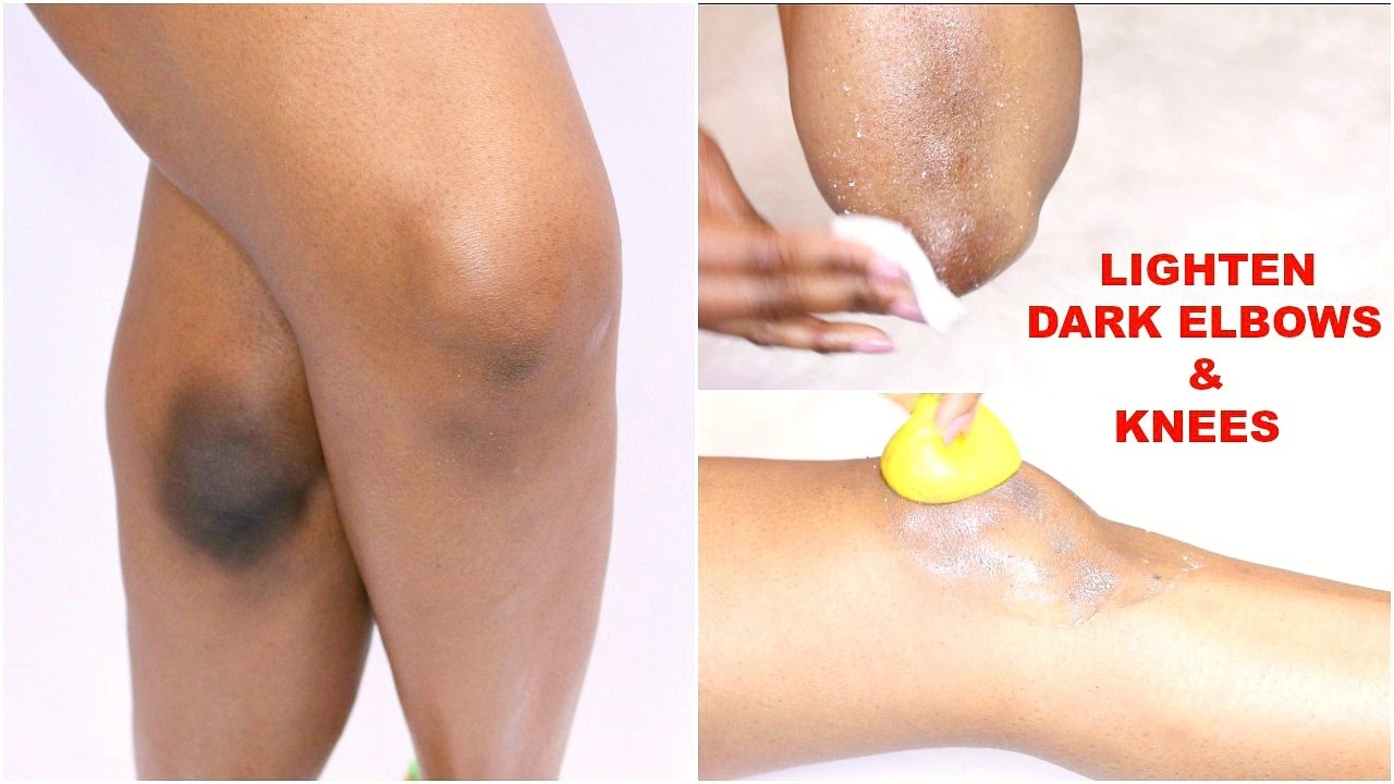 5 ways to naturally get rid of dark elbows and knees ...