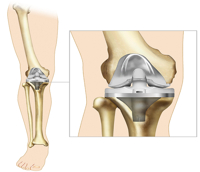 6 Things to Learn About Your New Knee Replacement
