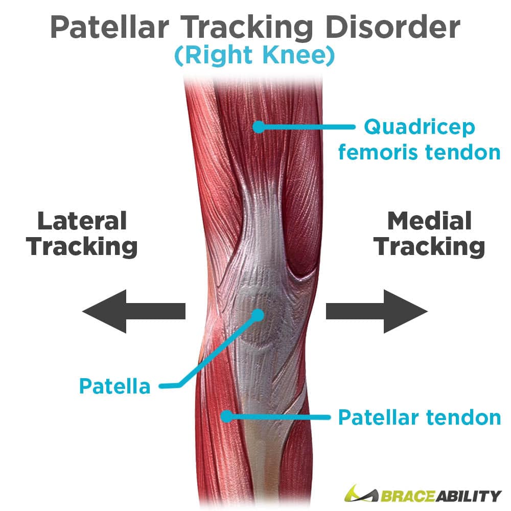 7 Patellar Tracking Exercises for Subluxation &  Dislocation