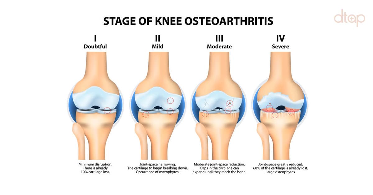 8 Common Symptoms of Knee Osteoarthritis (OA)