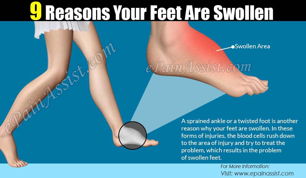 9 Reasons Your Feet Are Swollen