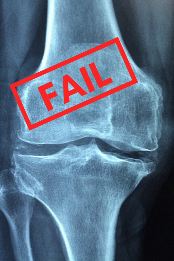9 Signs of Knee Replacement Failure in 2020