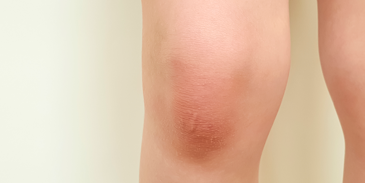 9 Swollen Knees Causes, Say Doctors