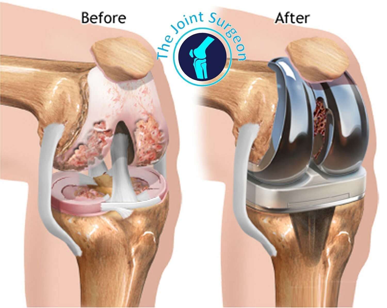 A Total Knee Replacement surgery is one of the most common ...