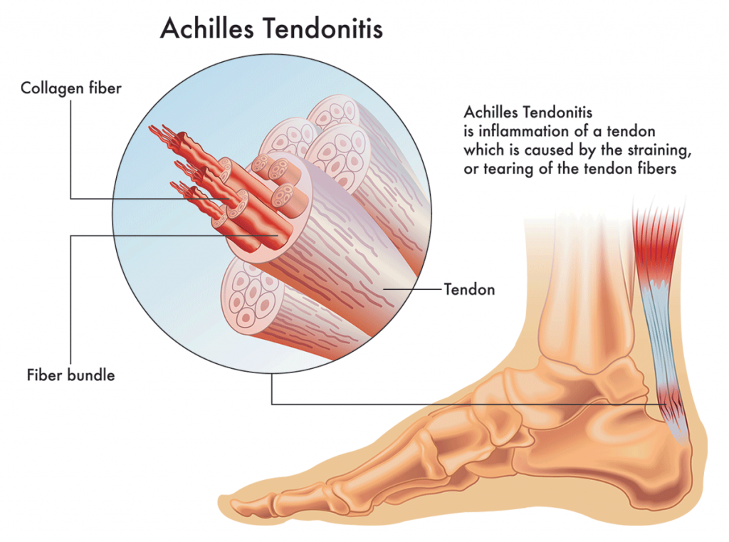 Achilles Tendon Pain: Causes, Treatments &  Prevention