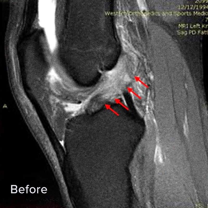 ACL Tear Repair Without Surgery