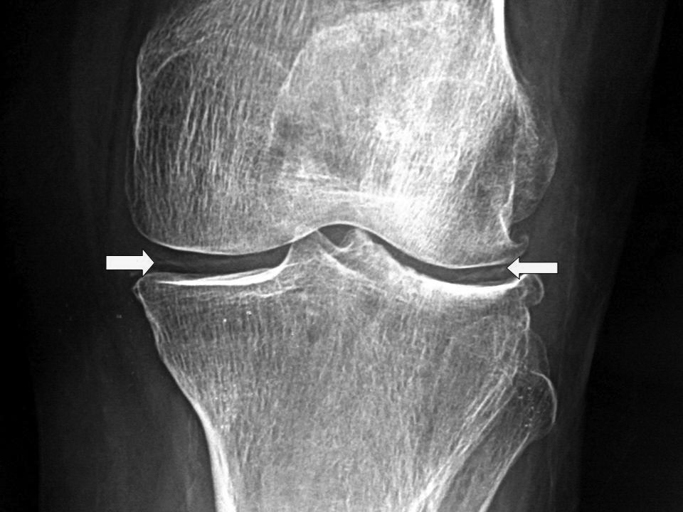 Acute Knee Pain