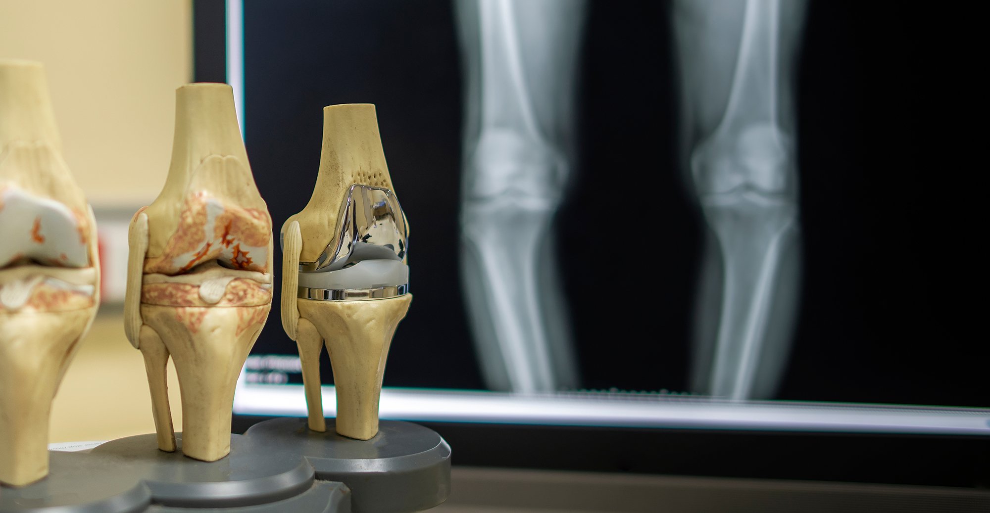 Advanced Total Knee Replacement Surgery in India at ...