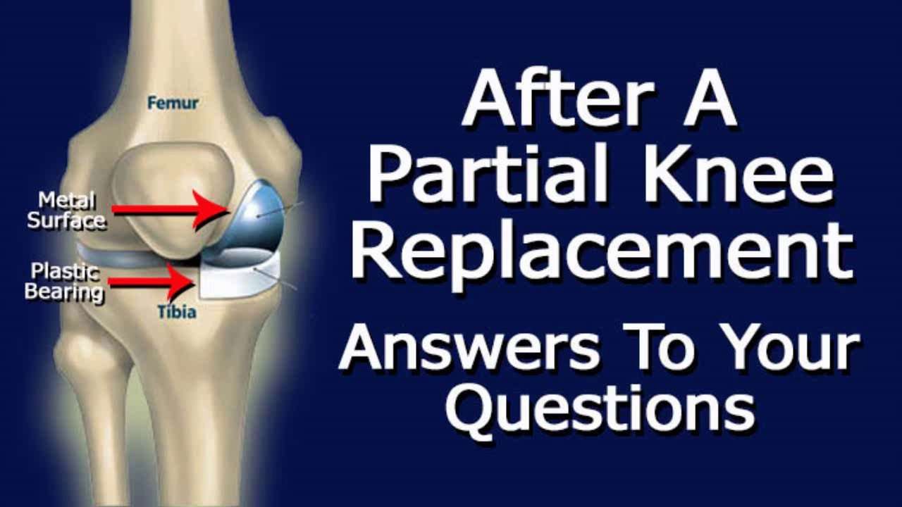 After Partial Knee Replacement Surgery: Answers To Your ...
