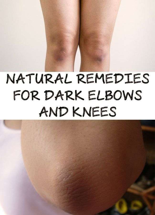 Amazing! Find out natural remedies to get rid of dark elbows and knees ...