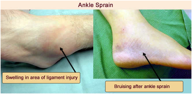 Ankle Sprain &  Fractures