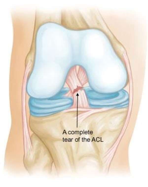 Anterior Cruciate Ligament (ACL) Injuries