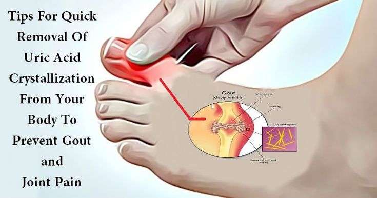 Arthritis in the bones in the feet is often caused by ...