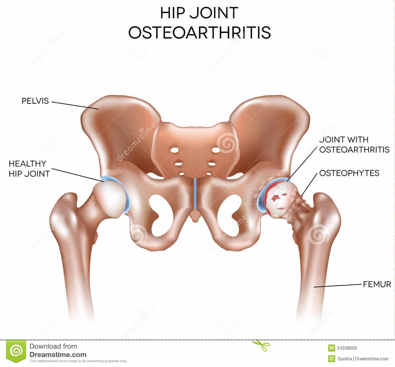 Arthritis of the hip joint stock vector. Illustration of bony