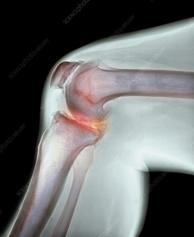 Arthritis of the knee, X