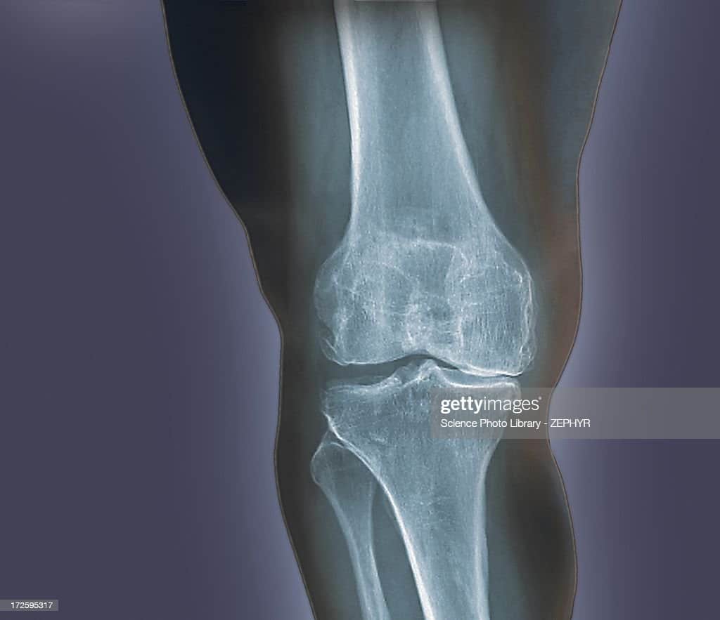 Arthritis Of The Knee Xray Foto de stock