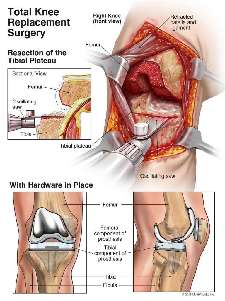 Arthroplasty of the Knee (Replacement)