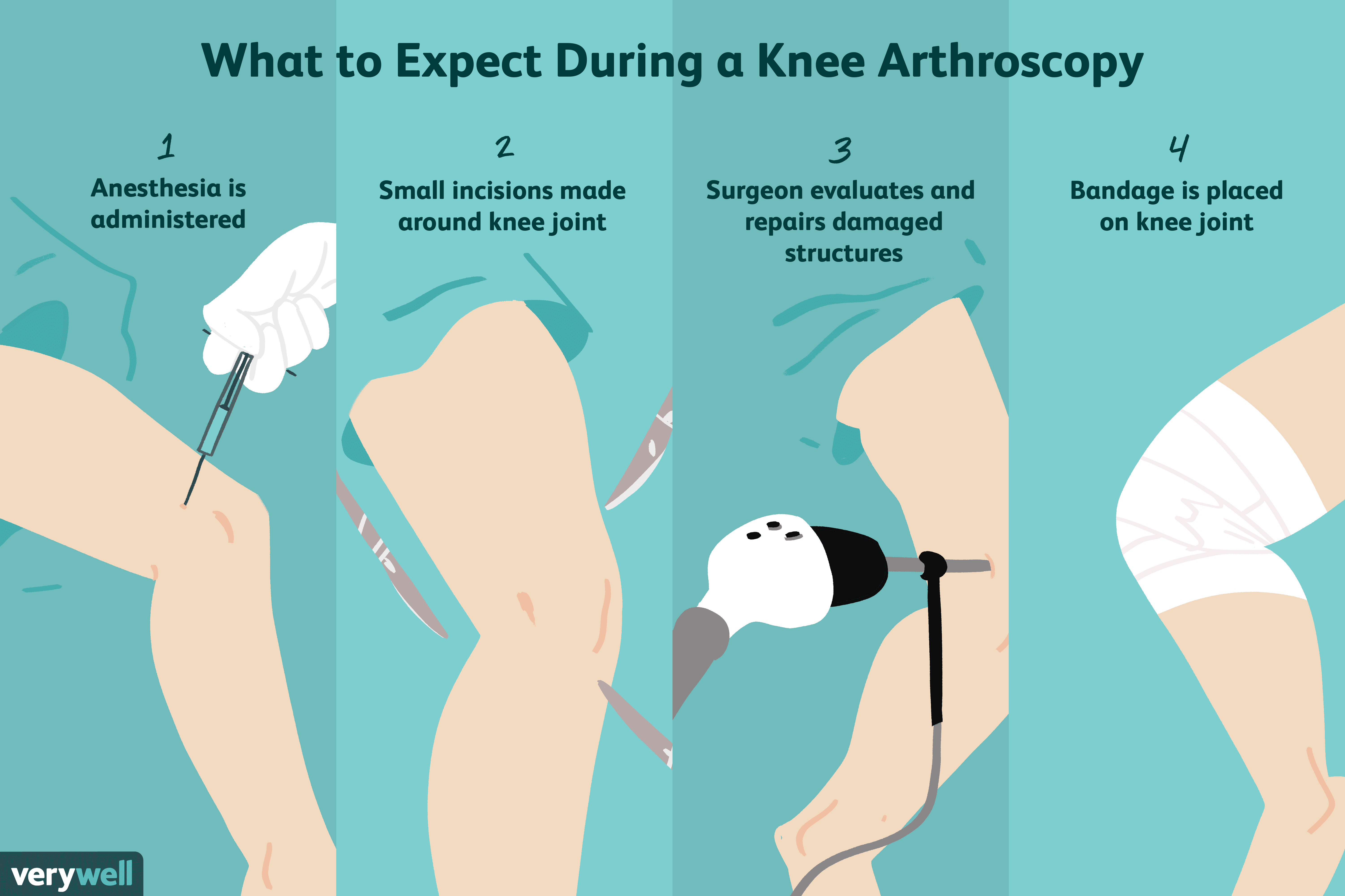 Arthroscopic Knee Surgery Side Effects