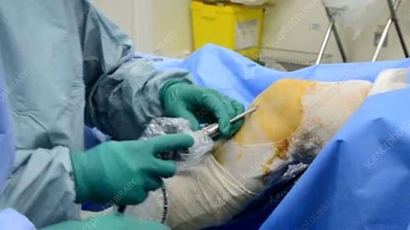 Arthroscopic knee surgery
