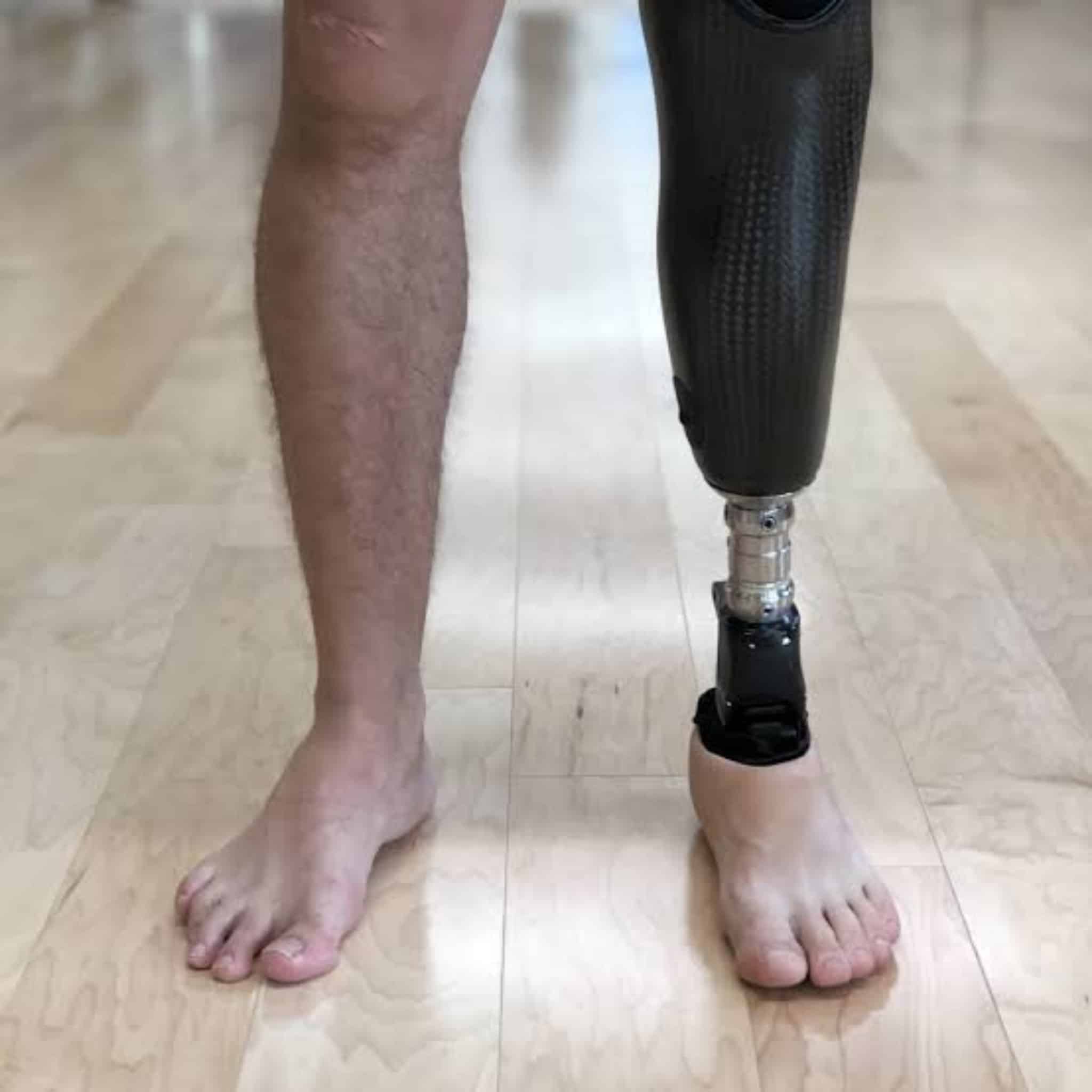 Artificial Below Knee Prosthesis, Artificial leg