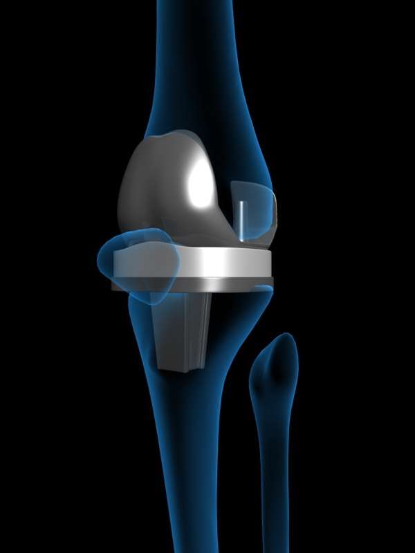 artificial knee replacement 3d model