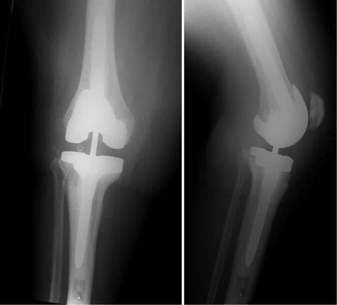 Aseptic Failure in Total Knee Arthroplasty