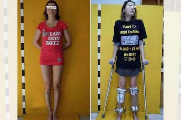 Aspiring Model Gets Leg Surgery to Increase Her Height to ...