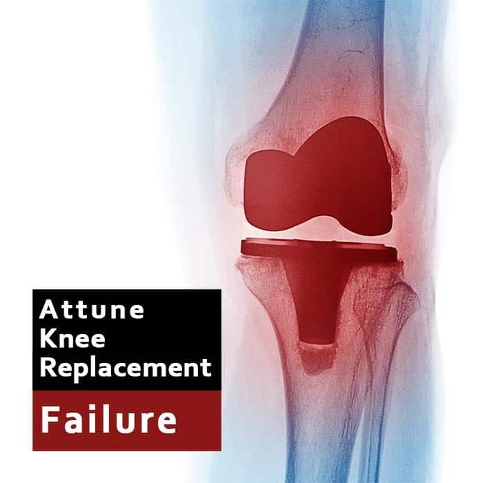 Attune Knee Replacement Failure Lawsuit