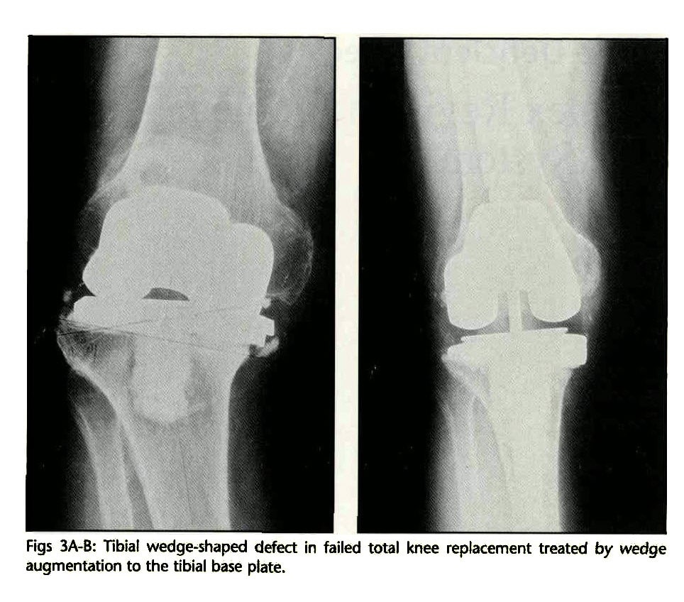 Augmentation Options in Total Knee Replacement