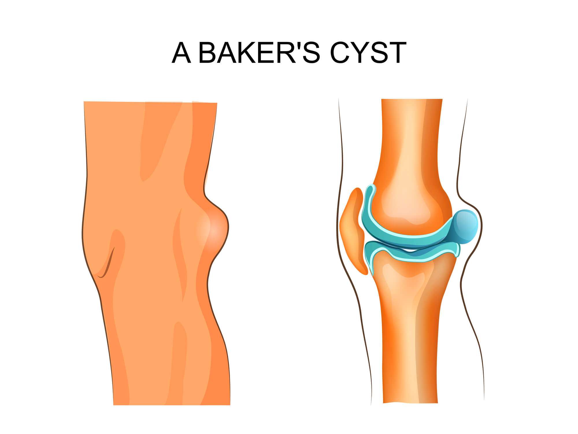 Bakerâs Cyst, Causes and Treatment