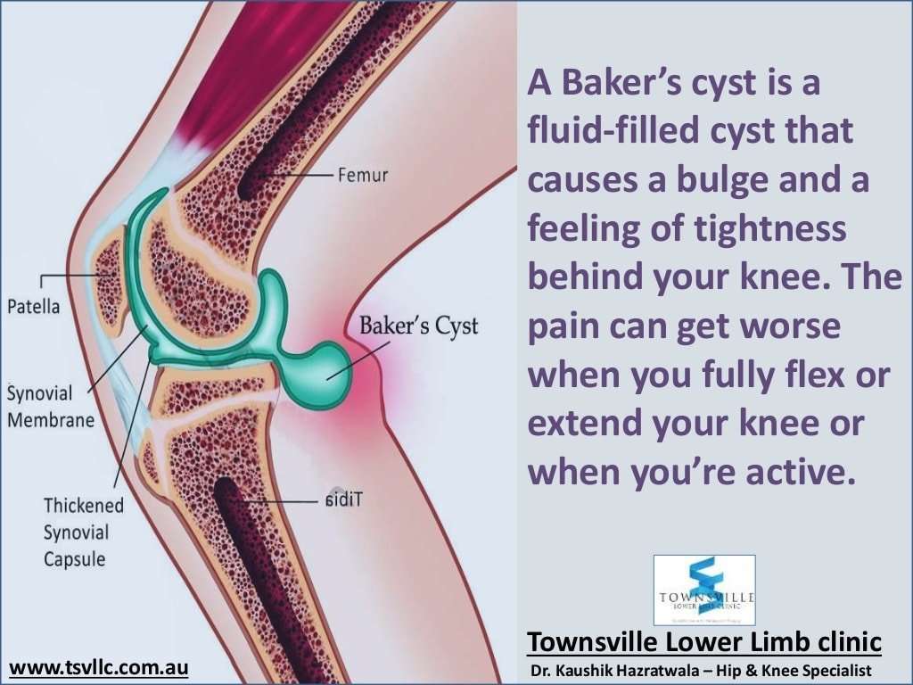 Bakers Cyst of The Knee