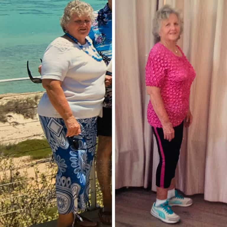 Bariatric surgery results from real people in Perth