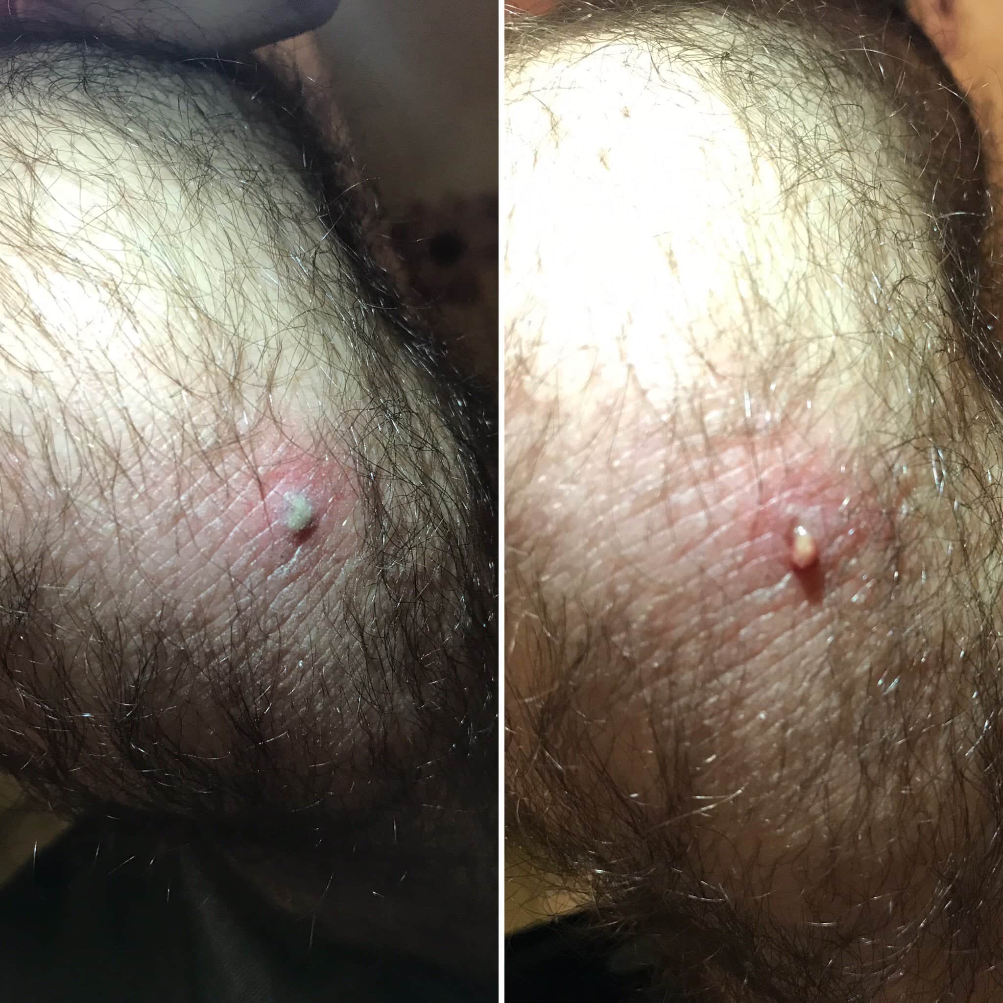 Before and after I lanced my SOs infected knee pimple : popping