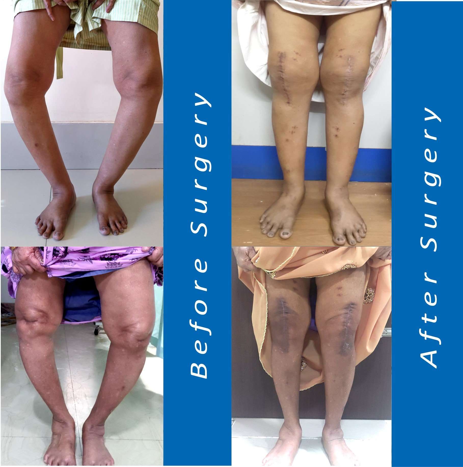 Best Knee Replacement Surgery in Chennai